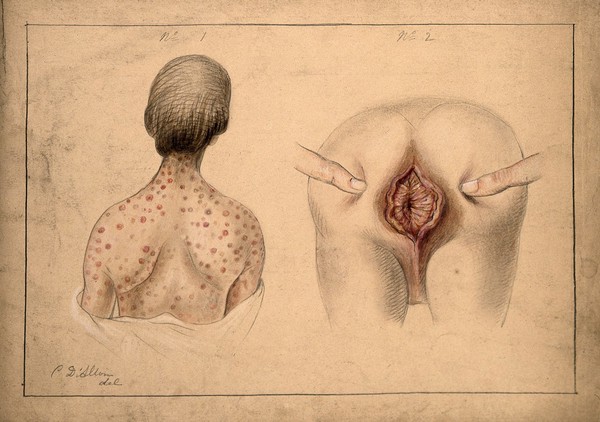 The diseased back and neck of a woman, shown beside a detail of diseased tissue around the anus of her young son. Watercolour by C. D'Alton, 1871.