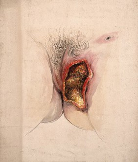 Female genitalia showing severely diseased tissue. Watercolour by C. D'Alton, 1859.