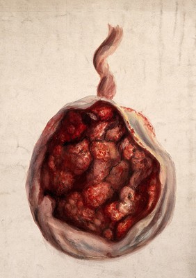 A syphilitic placenta. Watercolour by C. D'Alton, ca. 1853.