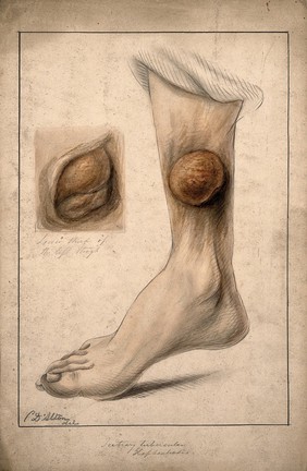 Tertiary tubercular elephantiasis on the thigh and calf of a woman. Watercolour by C. D'Alton, 1874.