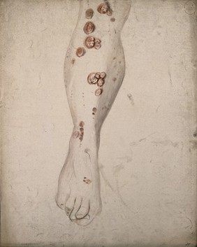 Sores and diseased skin on the leg of a woman. Watercolour by C. D'Alton, ca. 1850.