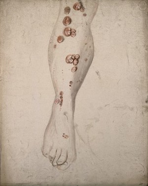 view Sores and diseased skin on the leg of a woman. Watercolour by C. D'Alton, ca. 1850.