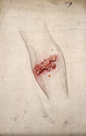 Sores and diseased skin on the arm of a woman. Watercolour by C. D'Alton, ca. 1847.