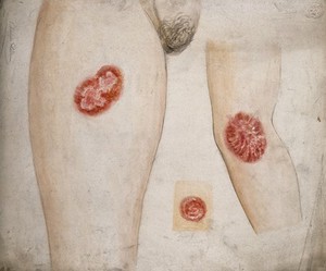 view Sores and diseased skin on the leg, arm and neck of a woman. Watercolour by C. D'Alton, 1857.