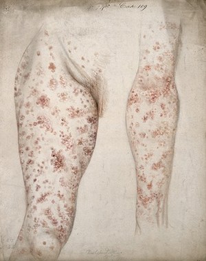 view Sores and diseased skin on the leg and arm of a woman. Watercolour by C. D'Alton, 1856.