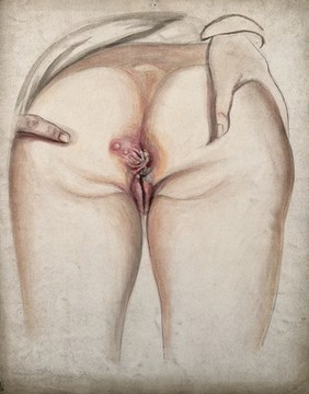 Diseased skin surrounding the anus of a woman, as seen from behind, with two fingers holding the buttocks apart. Watercolour by C. D'Alton, ca. 1853.