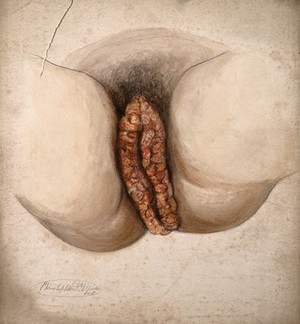 view Female genitalia showing severely diseased tissue. Watercolour by C. D'Alton, 18--.