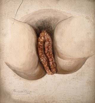 Female genitalia showing severely diseased tissue. Watercolour by C. D'Alton, 18--.