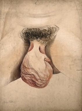 Female genitalia showing severely diseased tissue and hypertrophy of the clitoris. Watercolour by C. D'Alton, ca. 1857.