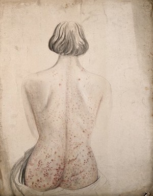 view Back and buttocks of a woman suffering from a rash of sores. Watercolour by C. D'Alton, ca. 1850.