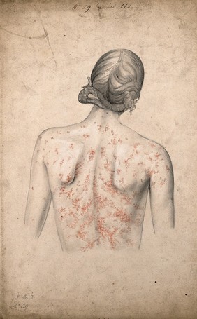 Back of a woman suffering from a rash of sores. Watercolour by C. D'Alton, 1855.