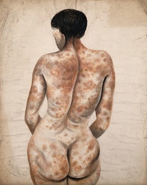 view Back and buttocks of a woman suffering from a disease affecting the skin. Watercolour by C. D'Alton, ca. 1850.