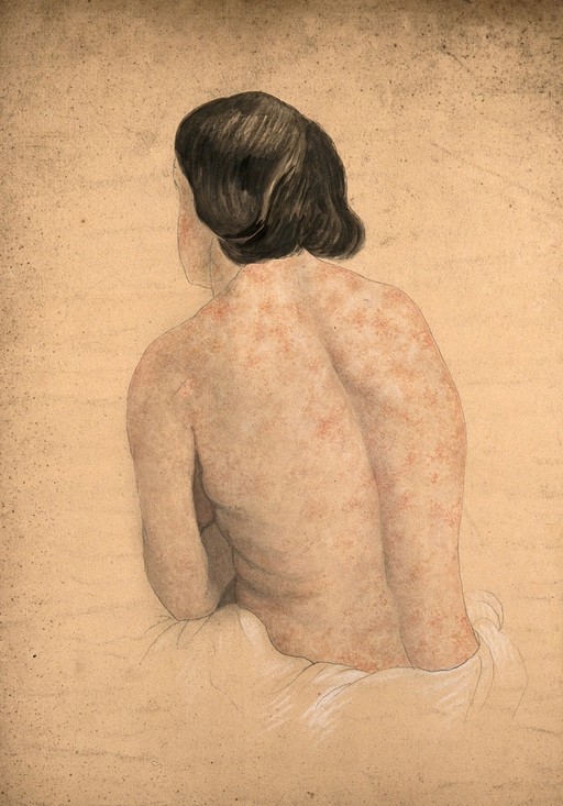 Syphilis; rash on woman's back, 1858