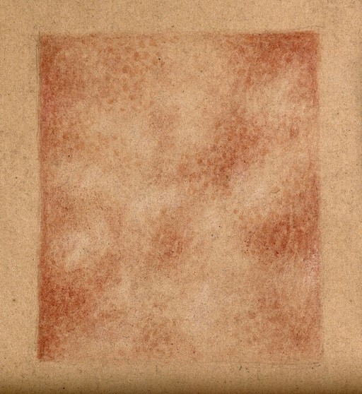 Syphilis; detail of skin rash, 1862