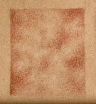 Square specimen showing a detail of the skin of a woman suffering from a rash caused by syphilis. Watercolour by C. D'Alton, 1862.