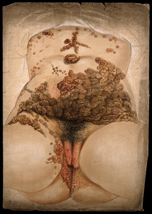 Syphilis; lesions on genitalia and torso of woman, 1862