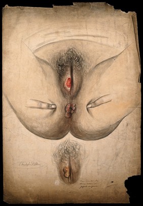 Diseased skin surrounding the anus and genitalia of a woman, with a detail of the area after treatment (?) Watercolour by C. D'Alton, ca. 1858.