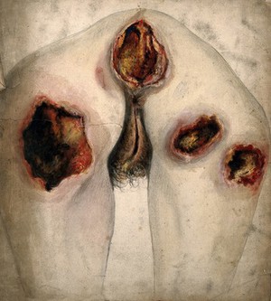 view Areas of severely diseased tissue on the buttocks and genitals of a woman. Watercolour by C. D'Alton, 1859.