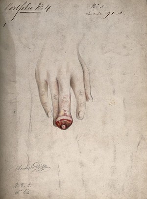 view Diseased, swollen fingertip. Watercolour by C. D'Alton, 1856.