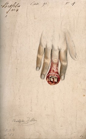 Diseased, swollen fingertip, with bone shown protruding from the open wound. Watercolour by C. D'Alton, 1856.