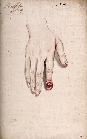 view Diseased, swollen fingertip. Watercolour by C. D'Alton, 1857.