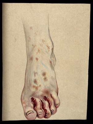 view Diseased foot and toes. Watercolour by C. D'Alton, ca. 1857.
