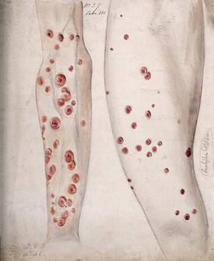 view Sores and diseased skin on the arm and leg of a woman. Watercolour by C. D'Alton, ca. 1847.