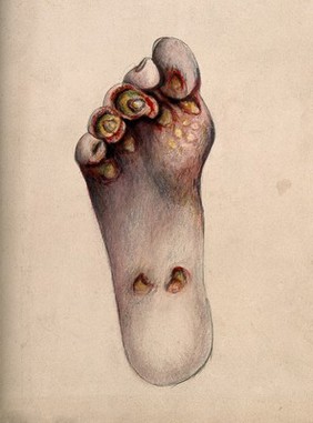 Diseased skin and sores on the toes and sole of a woman's foot. Watercolour by C. D'Alton, 1870.