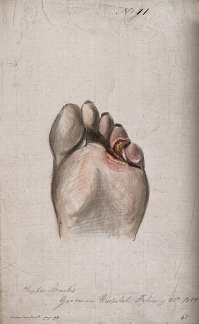 Diseased skin on the toes and sole of a man's foot. Watercolour by C. D'Alton, 1857.