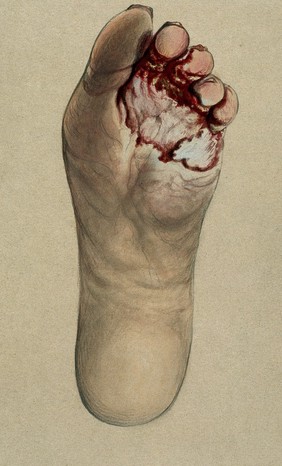 Diseased skin on the toes and sole of a woman's foot. Watercolour by C. D'Alton, ca. 1870.