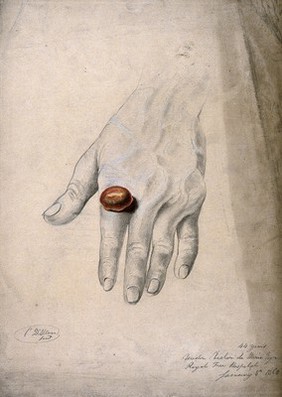 An abcess on the finger of a man. Watercolour by C. D'Alton, 1868.