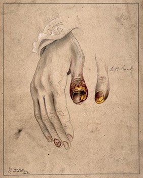 Diseased tissue on the thumbs and fingers of a woman, showing symptoms of syphilitic onychia. Watercolour by C. D'Alton, 1870.