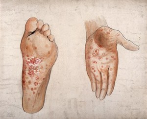view Diseased tissue on the palm of the hand and sole of the foot of a man. Watercolour by C. D'Alton, ca. 1853.