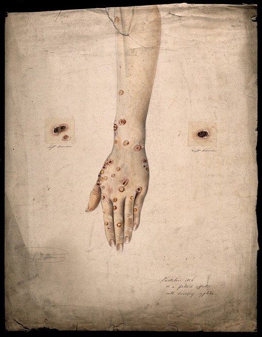 Syphilis; sores and pustules on woman's arm, 1858