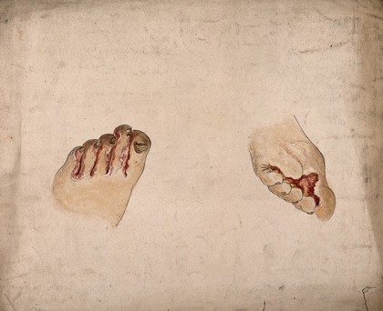 Diseased tissue on the toes and feet of a woman. Watercolour by C. D'Alton, 1858.