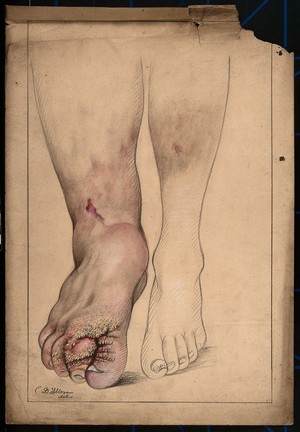 view Diseased and deformed foot, ankle and lower leg of a man. Watercolour by C. D'Alton, 1871.