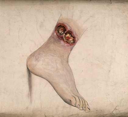 Diseased tissue on the ankle of a woman. Watercolour by C. D'Alton, 1859.