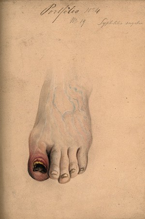 view Diseased tissue on the toe and nail of a woman (?), showing symptoms of syphilitic onychia. Watercolour by C. D'Alton, ca. 1870.