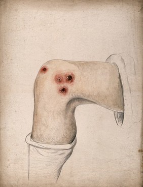 Diseased tissue on the knee of a man. Watercolour by C. D'Alton, ca. 1870.