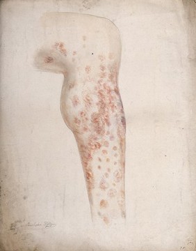 Diseased tissue on the lower leg of a man. Watercolour by C. D'Alton, 1857.