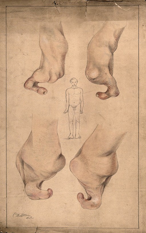 Lobster claw deformity, hands and feet, 1871