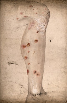 Diseased skin and sores on the leg of a man suffering from syphilis. Watercolour by C. D'Alton, 18--.