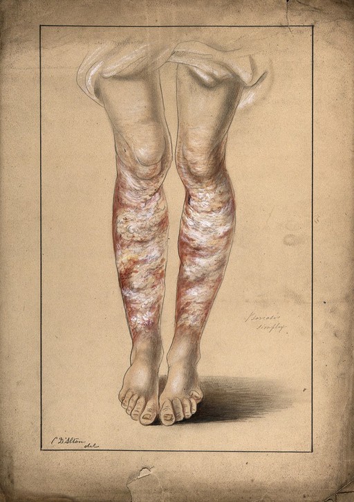 Psoriasis; legs of man aged 53, 1873