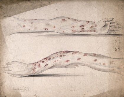 Diseased skin and sores on the arms of a man. Watercolour by C. D'Alton, 1850.