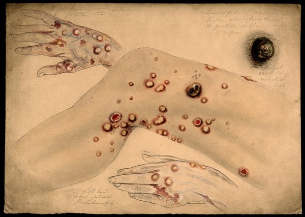 Diseased skin and boils on the hands, head and leg of a woman, showing symptoms of 'pustular itch'. Watercolour by C. D'Alton, 1866.