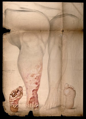 view The swollen legs and the damaged feet of a woman with disease diagnosed as syphilis. Watercolour by C. D'Alton, 1868.