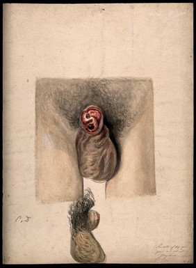 A diseased penis, showing symptoms of dry gangrene and sloughing phagedena. Watercolour by C. D'Alton, 1858.