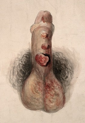 A diseased penis. Watercolour by C. D'Alton, 1858.