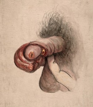 view A diseased penis showing symptoms of gangrene. Watercolour by C. D'Alton, 18--.