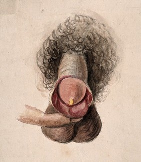 A diseased penis showing symptoms of gangrene. Watercolour by C. D'Alton, 1857.